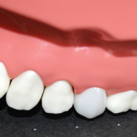 セラミック（e-max）